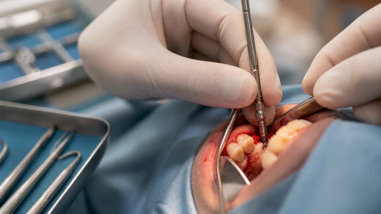 Surgeon placing dental implant post