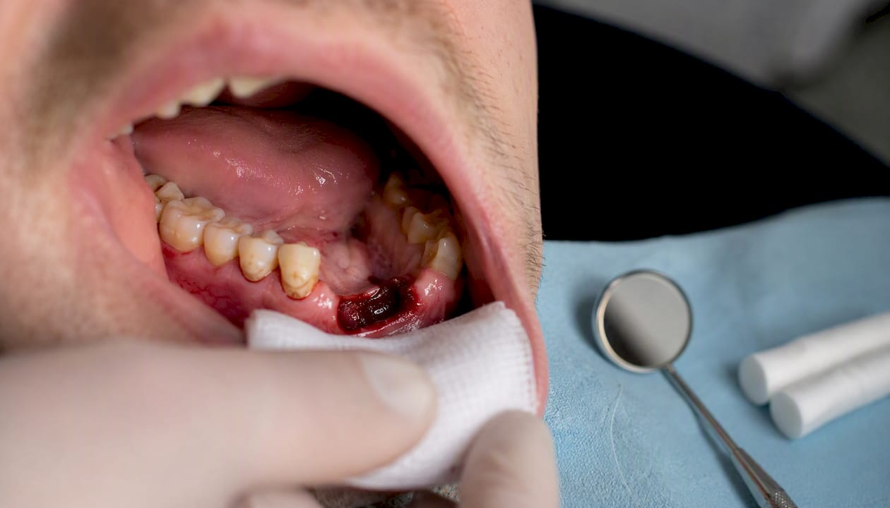 Close-up of protected blood clot post dental bone graft