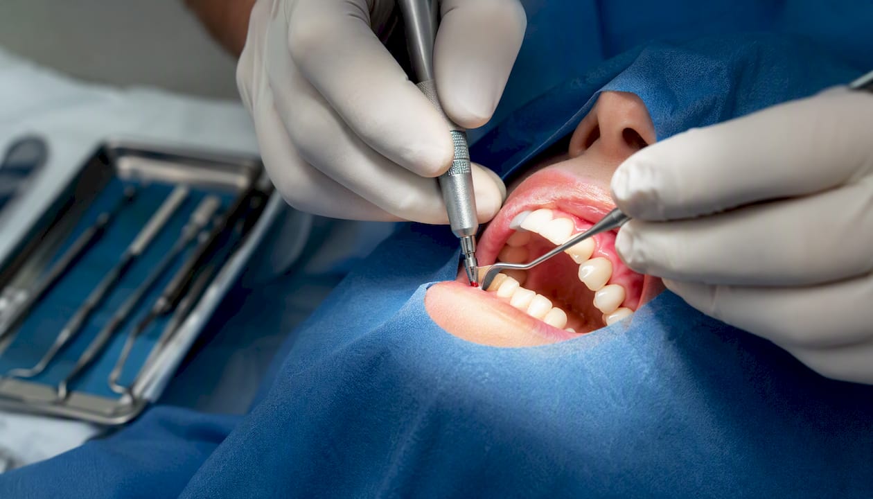 Dentist performing flapless implant tissue punch