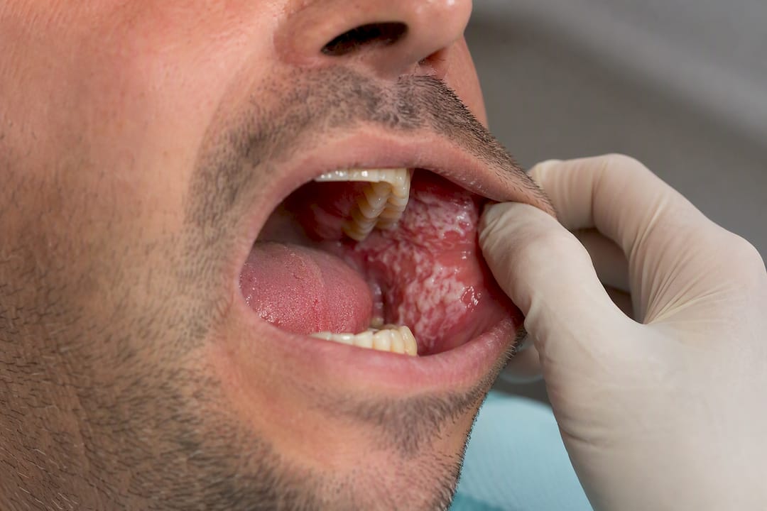 Close-up of oral candidiasis thrush on gums