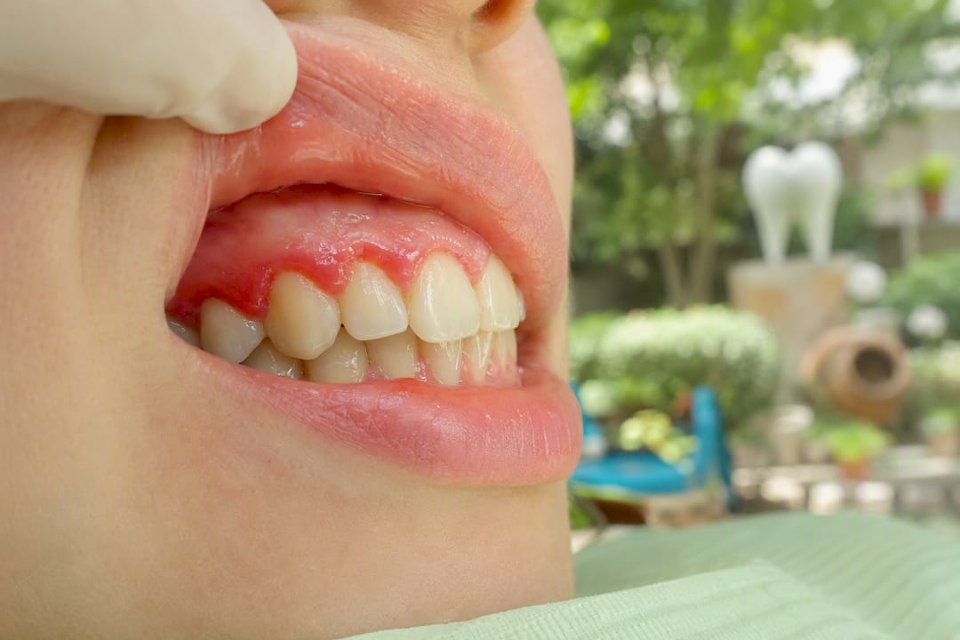 Close-up of inflamed gums showing gingivitis