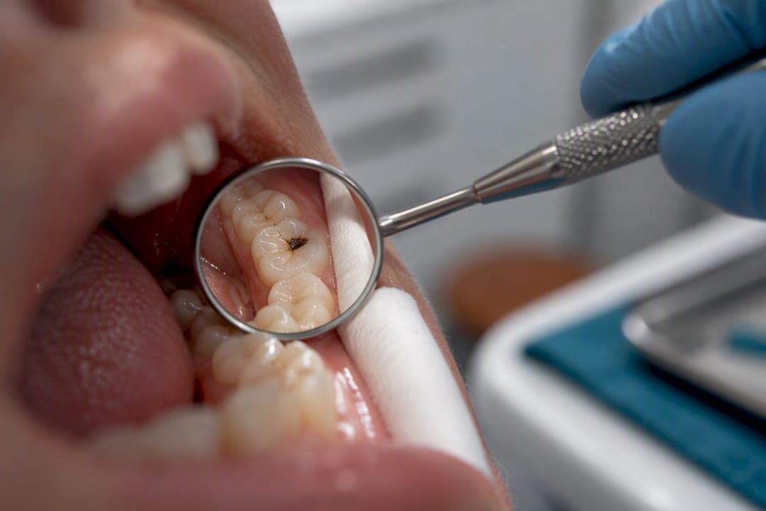 Tooth showing localized dark SDF staining